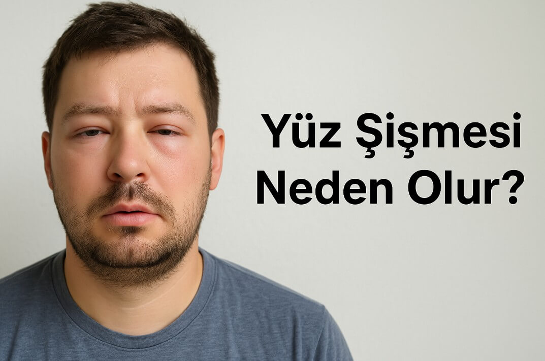 Yüz Şişmesi Neden Olur